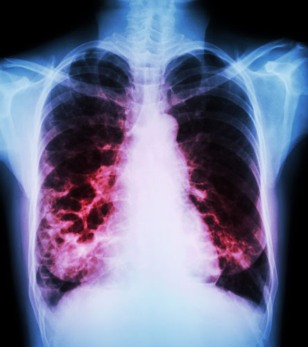 Chest X-rays