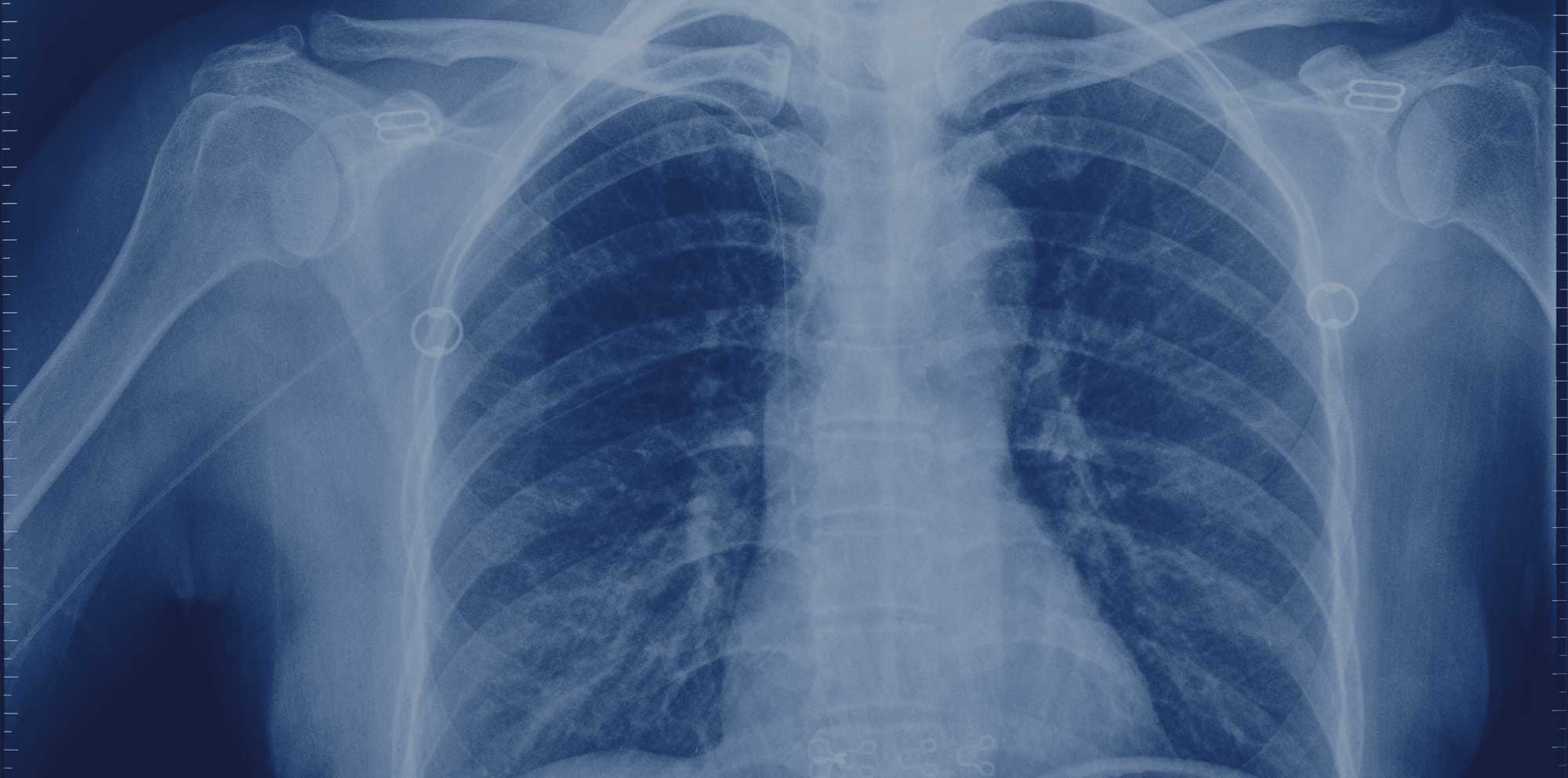 Symptoms of Pleural Mesothelioma background image