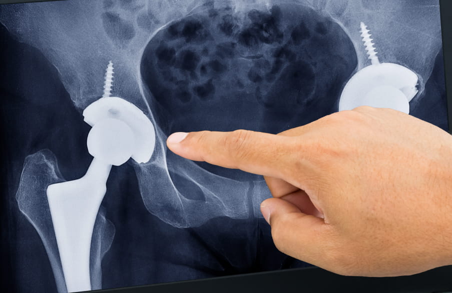 Exactech Hip Replacement Recalled Devices  background image