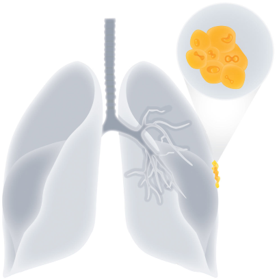 An image depicting a few cancer cells forming in the lining of a lung