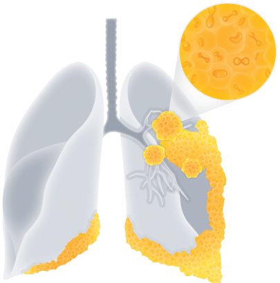 An image depicting cancer cells and tumors across one lung and into the second lung