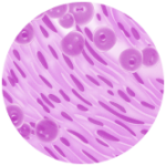 A combination of both epithelioid cells and sarcomatoid cells