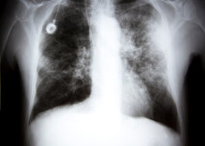 X-ray of the lungs