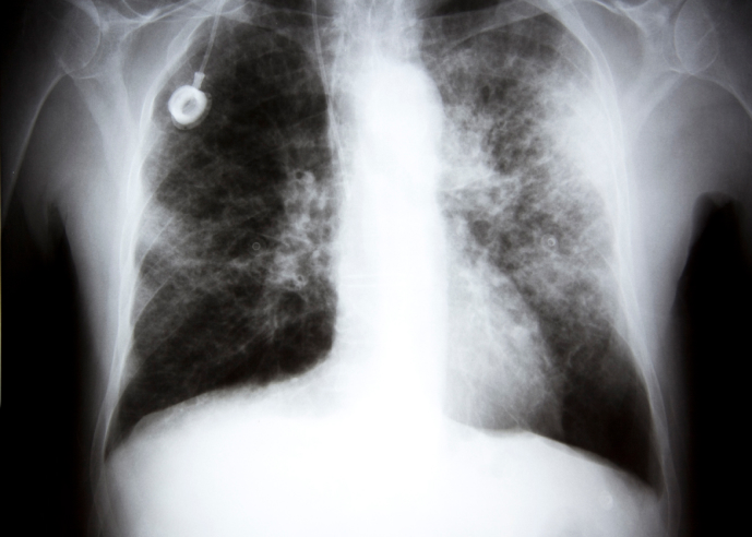 Lung X-rays