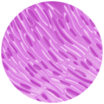 Straight, needle-like sarcomatoid cells