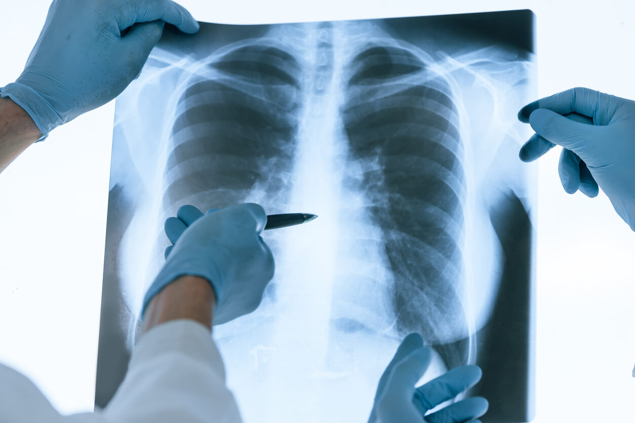 What You Need to Know About Mesothelioma background image