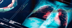 Lung X-ray