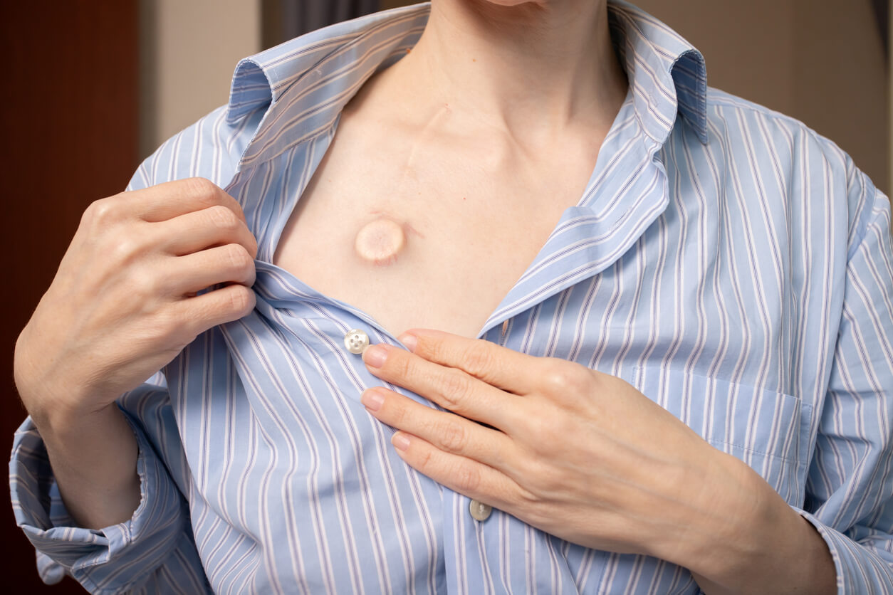 About the Bard Port Catheter Litigation background image